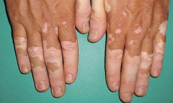 Điều trị bạch biến