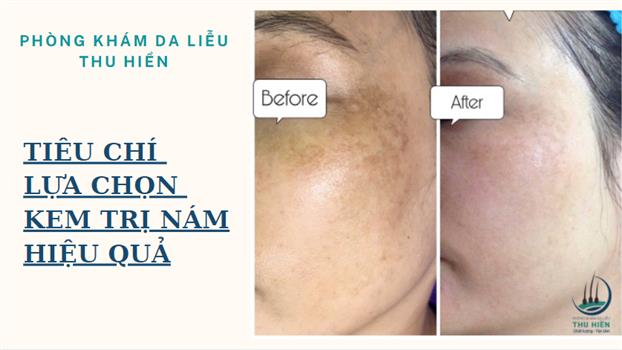 CHỌN KEM NÁM DỰA VÀO NHỮNG TIÊU CHÍ NÀO?