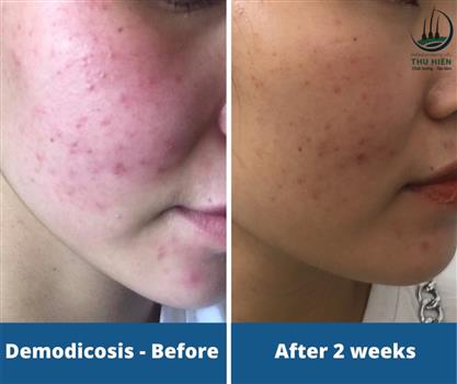  VIÊM DA DO DEMODEX TRONG MÙA HÈ NẮNG NÓNG- CÓ NGUY HIỂM KHÔNG?