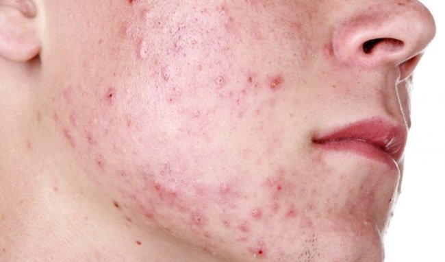 Bệnh do rối loạn phần phụ của da