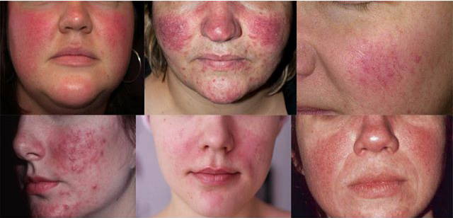 Trứng cá đỏ - Chứng đỏ da (Rosacea)