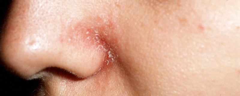 Viêm da dầu (Sheborrheic dermatitis)