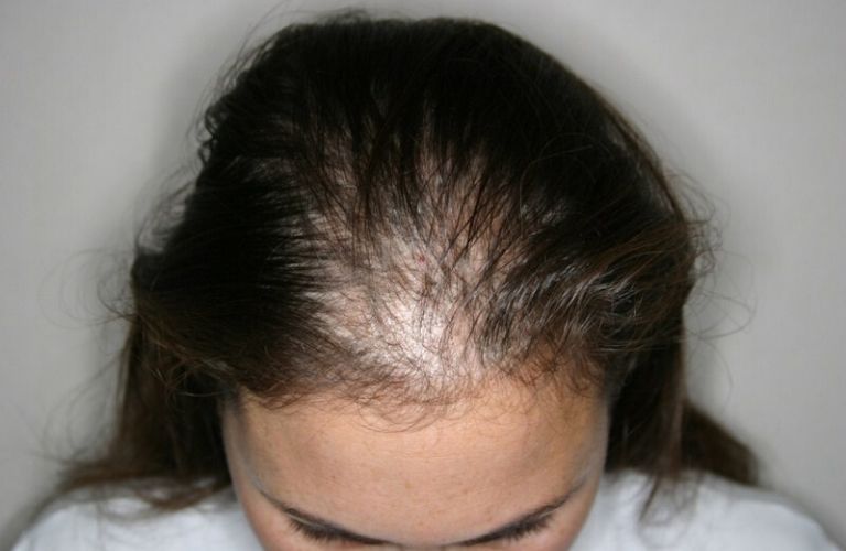 Rụng tóc do nội tiết tố nam (Androgenic Alopecia)