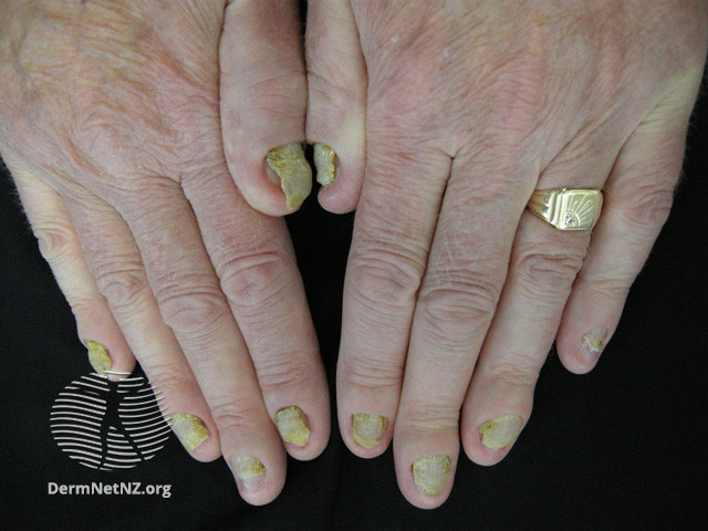 HỘI CHỨNG MÓNG TAY VÀNG (YELLOW NAIL SYNDROME)