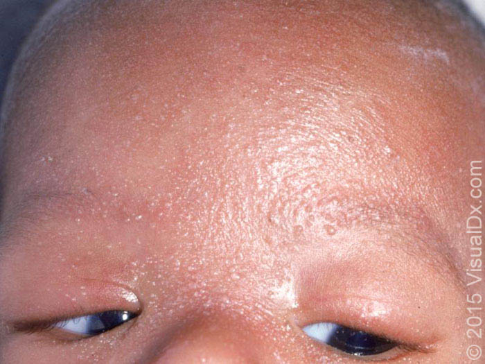 BỆNH RÔM SẢY (MILIARIA)