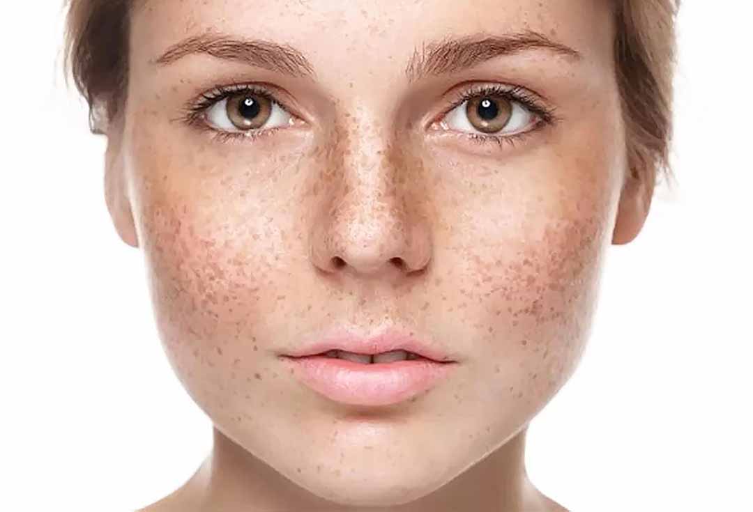 Bệnh rối loạn sắc tố da