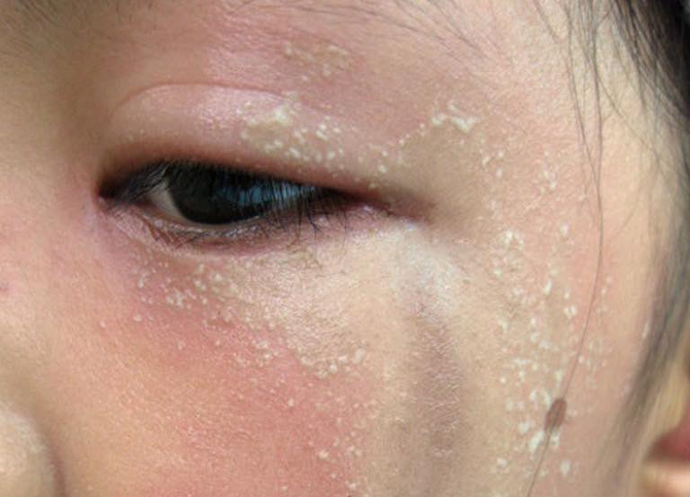 Viêm da tiếp xúc kích ứng do kiến ba khoang là gì