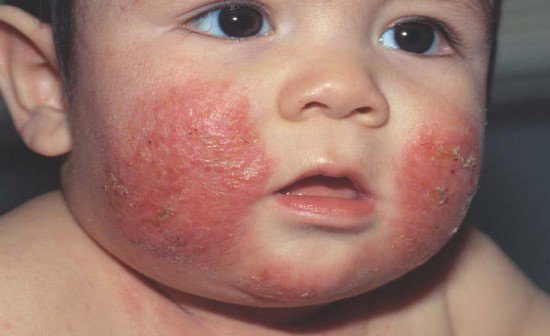 Bệnh viêm da cơ địa (Atopic Dermatitis-AD)