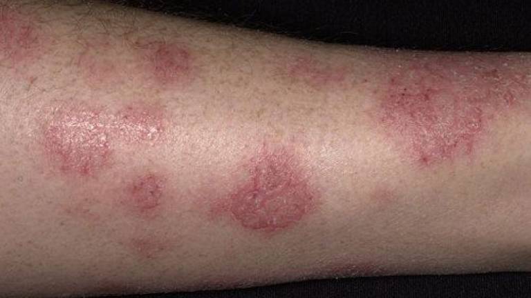 Chàm (Eczema)