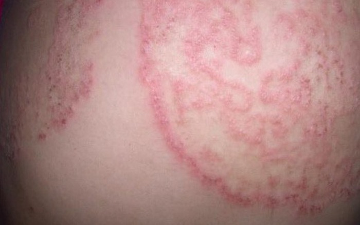 Bệnh nấm nông ở da (Superficial fungal skin infections)