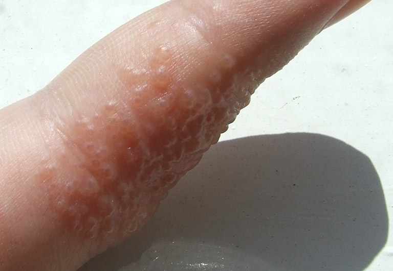 Tổ đỉa (dyshidrotic dermatitis)