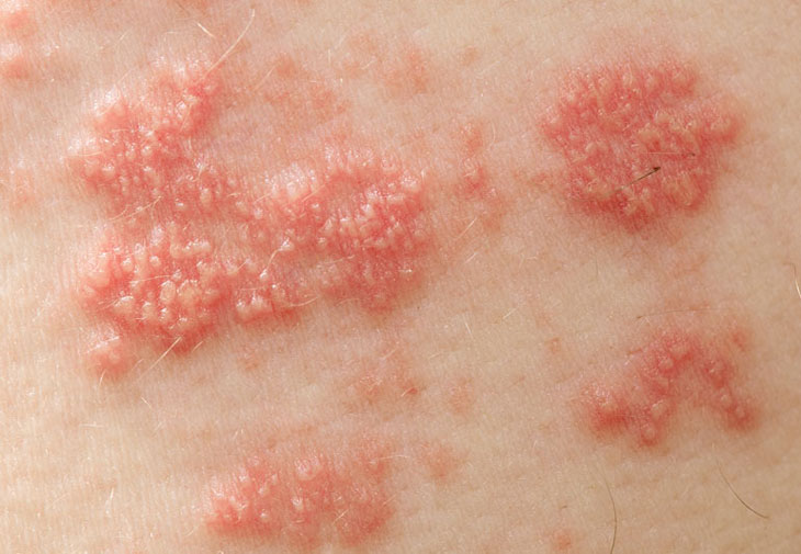 Bệnh Zona (Herpes zoster)