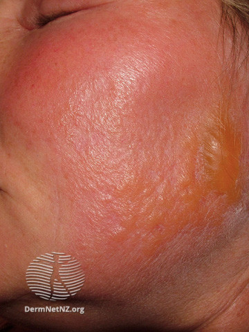 BỆNH VIÊM QUẦNG