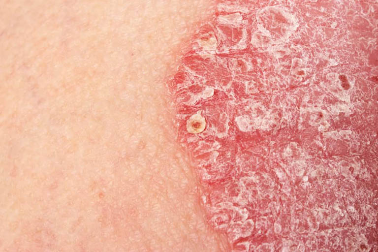 Bệnh do bất thường sừng hóa da