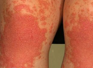 Vảy phấn đỏ nang lông (Pityriasis Rubra Pilaris)
