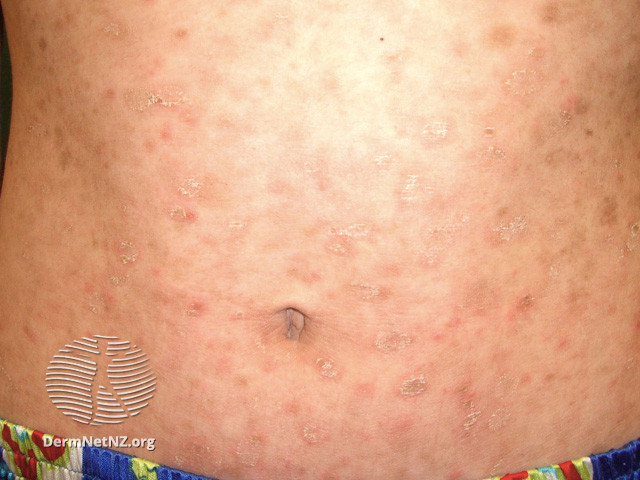 Á vảy nến (Parapsoriasis)