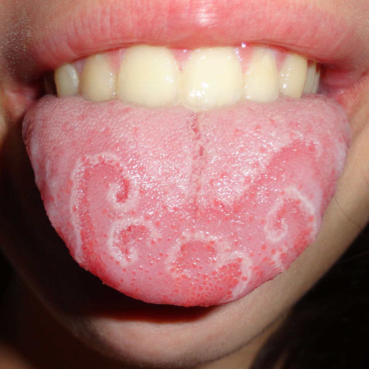 Lưỡi bản đồ (Geographic tongue)