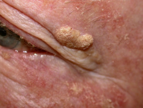 DÀY SỪNG DA DẦU (Seborrhoeic keratosis)