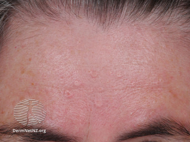 QUÁ SẢN TUYẾN BÃ (Sebaceous hyperplasia)