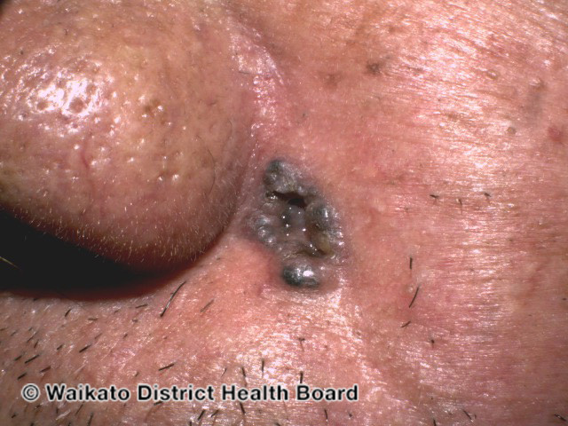 UNG THƯ TẾ BÀO ĐÁY (Basal cell carcinoma – BCC)