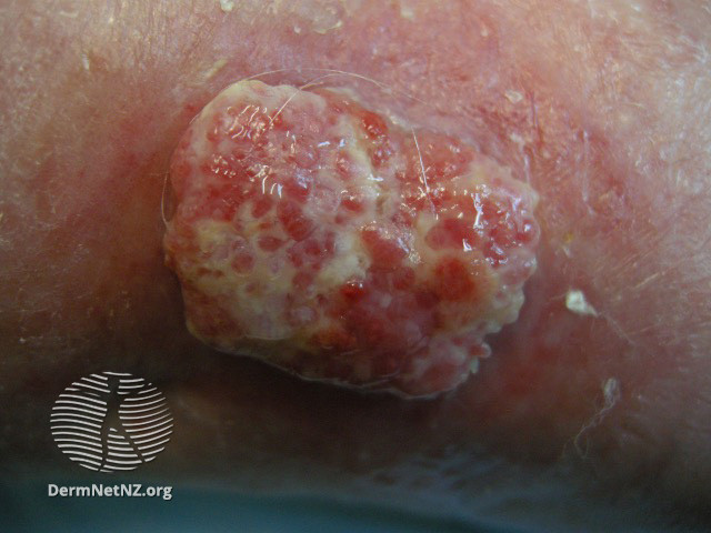 UNG THƯ TẾ BÀO VẢY (SQUAMOUS CELL CARCINOMA)