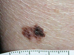 UNG THƯ TẾ BÀO HẮC TỐ (MELANOMA)