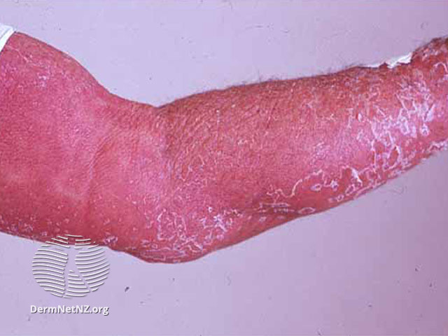 Ban đỏ và bệnh đỏ da (viêm da bong vảy)