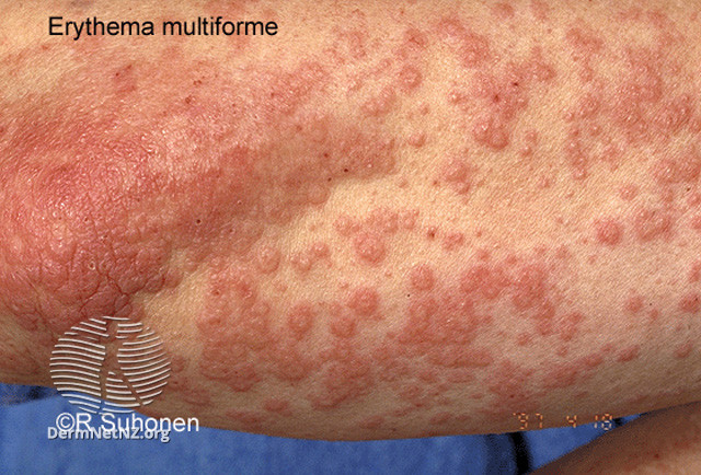 Hồng ban đa dạng (Erythema multiforme)