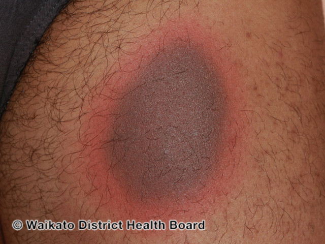 Phản ứng da do thuốc 