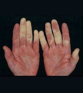 Hội chứng Raynaud