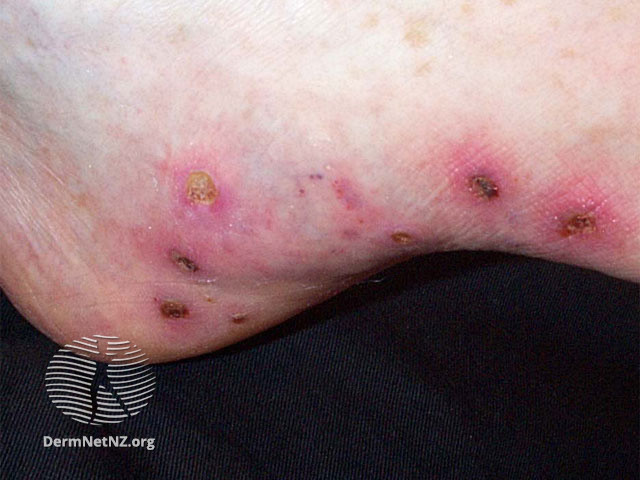 Viêm mạch (Vasculitis)