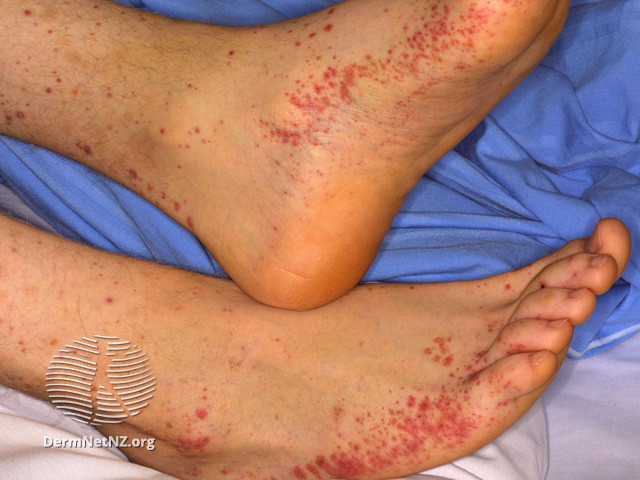 BAN XUẤT HUYẾT SCHOLEIN – HENOCH (Henoch–Schönlein purpura)