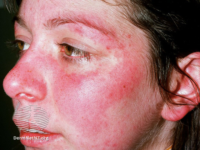 Bệnh Lupus ban đỏ hệ thống (Systemic lupus erythematosus- SLE)