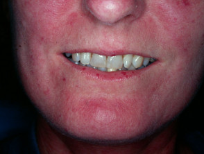 Xơ cứng bì hệ thống (Systemic Sclerosis)