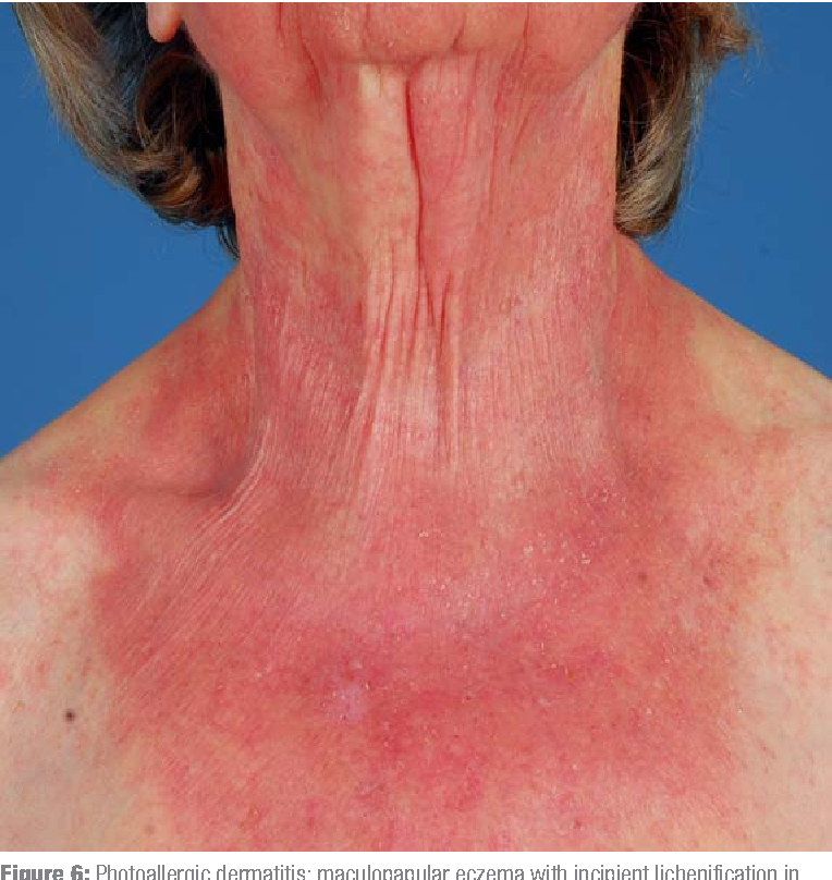 Bệnh da nhạy cảm ánh sáng (Photosensitivity)