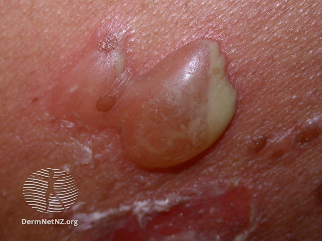 Bệnh da bọng nước 