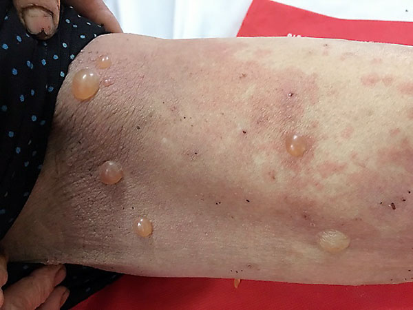 Pemphigoid bọng nước (Bullous pemphigoid-BP)