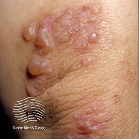  Bệnh Duhring - Brocq (DH)/ Dermatitis Herpetiformis