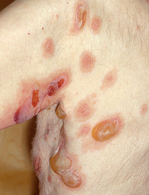 BỆNH PEMPHIGOID VÀ PEMPHIGUS