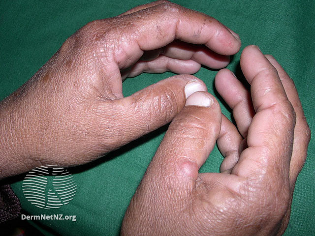 Bệnh da do rối loạn chuyển hóa