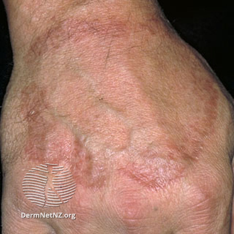 U HẠT VÒNG (Granuloma Annulare)