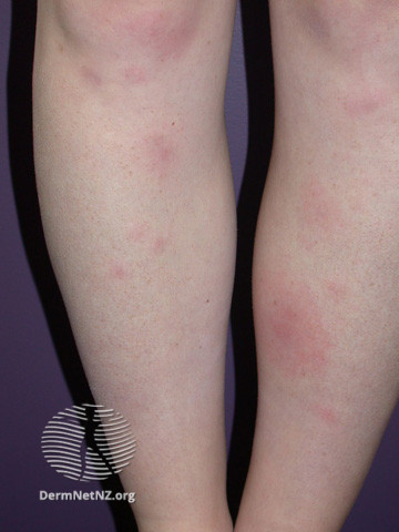 Hồng ban nút (Erythema Nodosum)