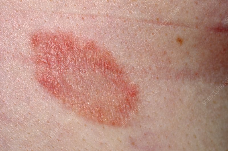 Vảy phấn hồng (Pityriasis rosea)