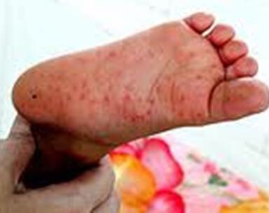 Bệnh tay chân miệng (Hand, foot and mouth disease)