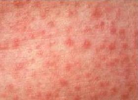 SỞI (Measles / Rubeola) 