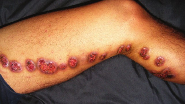 Các bệnh nấm sâu (Deep Fungal Infections)   