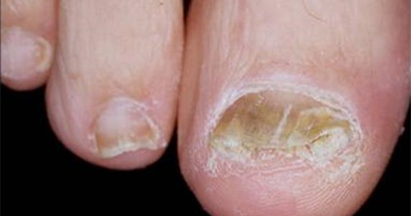 Bệnh nấm móng (Onychomycosis)