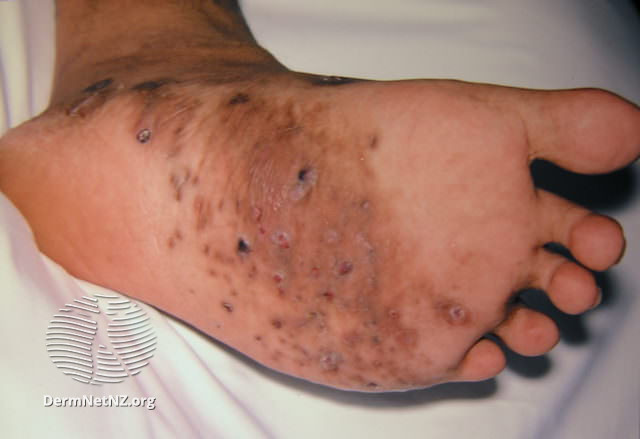Nấm sâu Mycetoma (Maduromycosis, Madura Foot)