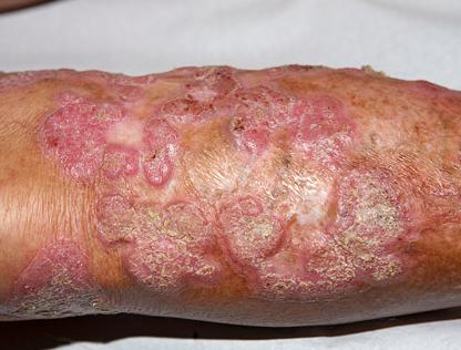 Nấm sâu Chromomycois (Chromomycosis – Chromoblastomycosis)