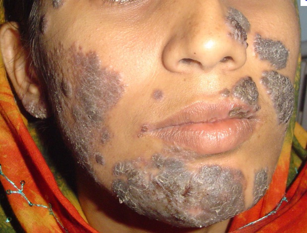 Nấm sâu Phaeohyphomycois (Phaeomycotic cyst, Cystic Chromomycosis)